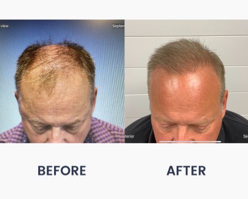 Before and After Medical Spa Gallery by Regency Medical Spa in Barrington, IL