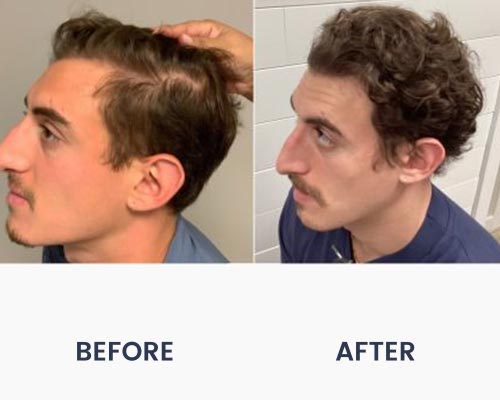 Before and After Medical Spa Gallery by Regency Medical Spa in Barrington, IL Before and After Medical Spa Gallery by Regency Medical Spa in Barrington, IL