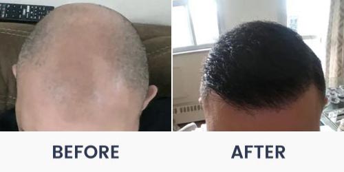 Before and After Medical Spa Gallery by Regency Medical Spa in Barrington, IL Before and After Medical Spa Gallery by Regency Medical Spa in Barrington, IL