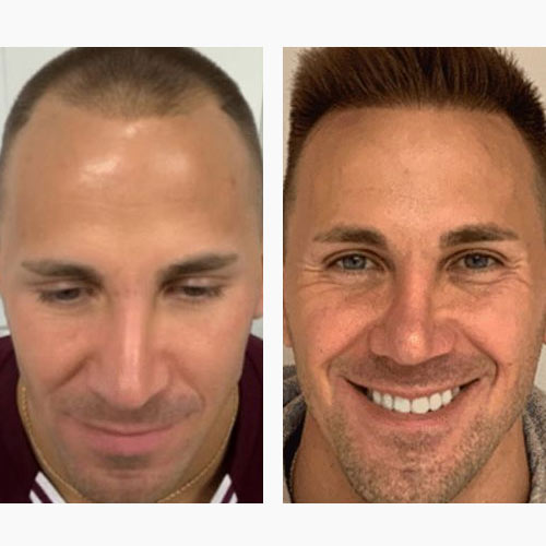 Before and After Medical Spa Gallery by Regency Medical Spa in Barrington, IL Before and After Medical Spa Gallery by Regency Medical Spa in Barrington, IL