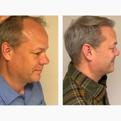 Before and After Medical Spa Gallery by Regency Medical Spa in Barrington, IL Before and After Medical Spa Gallery by Regency Medical Spa in Barrington, IL
