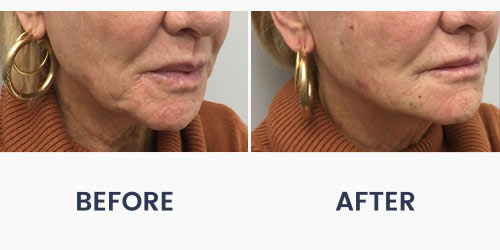 Before and After Medical Spa Gallery by Regency Medical Spa in Barrington, IL