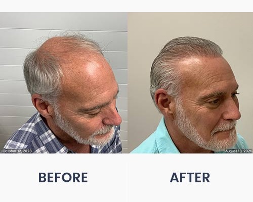 Before and After Medical Spa Gallery by Regency Medical Spa in Barrington, IL