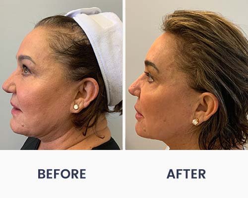 Before and After Medical Spa Gallery by Regency Medical Spa in Barrington, IL