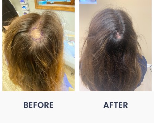 Before and After Medical Spa Gallery by Regency Medical Spa in Barrington, IL