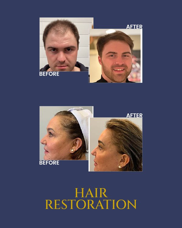 Hair Restoration Treatment Specialist in Barrington, IL Hair Restoration Treatment Specialist in Barrington, IL
