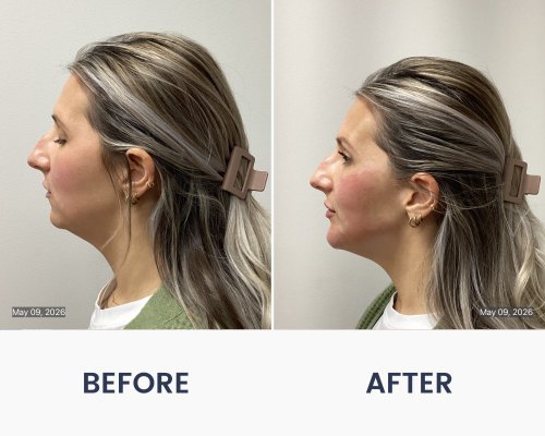 Before and After Medical Spa Gallery by Regency Medical Spa in Barrington, IL