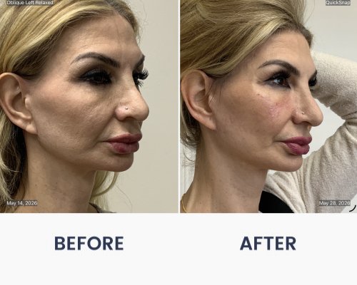 Before and After Medical Spa Gallery by Regency Medical Spa in Barrington, IL