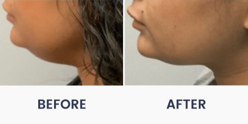 Before and After Medical Spa Gallery by Regency Medical Spa in Barrington, IL