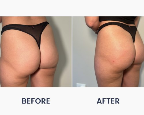 Before and After Medical Spa Gallery by Regency Medical Spa in Barrington, IL