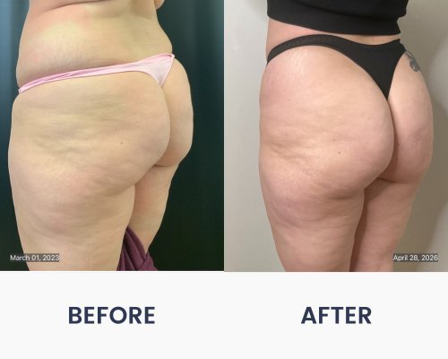 Before and After Medical Spa Gallery by Regency Medical Spa in Barrington, IL