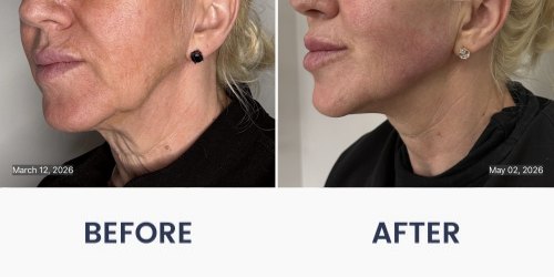 Before and After Medical Spa Gallery by Regency Medical Spa in Barrington, IL