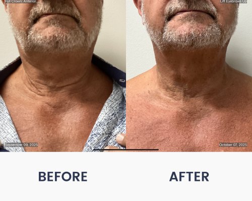 Before and After Medical Spa Gallery by Regency Medical Spa in Barrington, IL