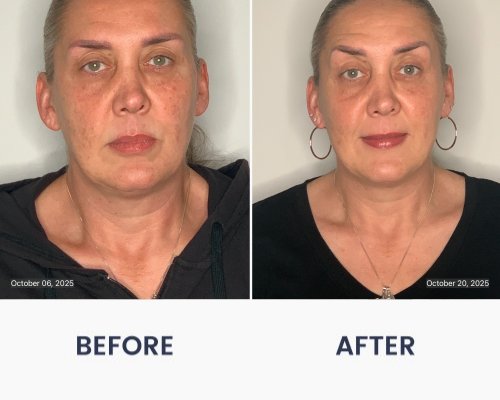 Before and After Medical Spa Gallery by Regency Medical Spa in Barrington, IL