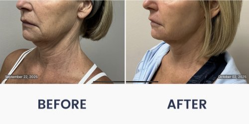 Before and After Medical Spa Gallery by Regency Medical Spa in Barrington, IL
