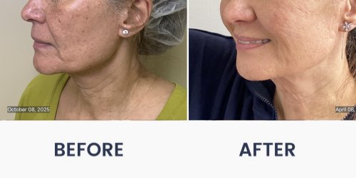 Before and After Medical Spa Gallery by Regency Medical Spa in Barrington, IL