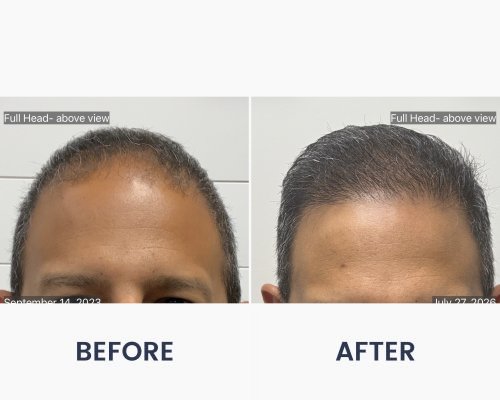 Before and After Medical Spa Gallery by Regency Medical Spa in Barrington, IL Before and After Medical Spa Gallery by Regency Medical Spa in Barrington, IL